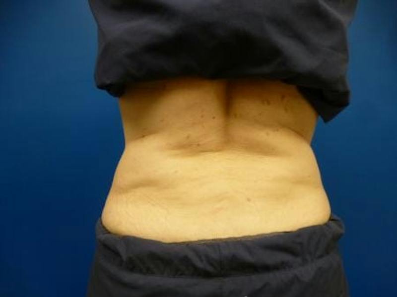 Sculpsure Before & After Gallery - Patient 385471 - Image 5