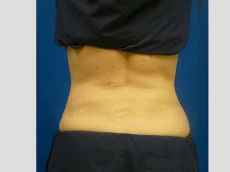 Sculpsure Before & After Gallery - Patient 385471 - Image 6