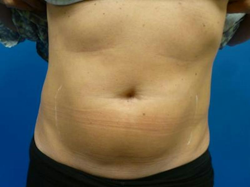 Sculpsure Before & After Gallery - Patient 387486 - Image 1