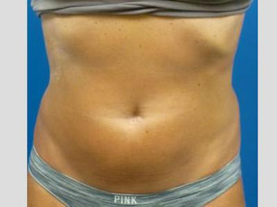 Sculpsure Before & After Gallery - Patient 387486 - Image 2