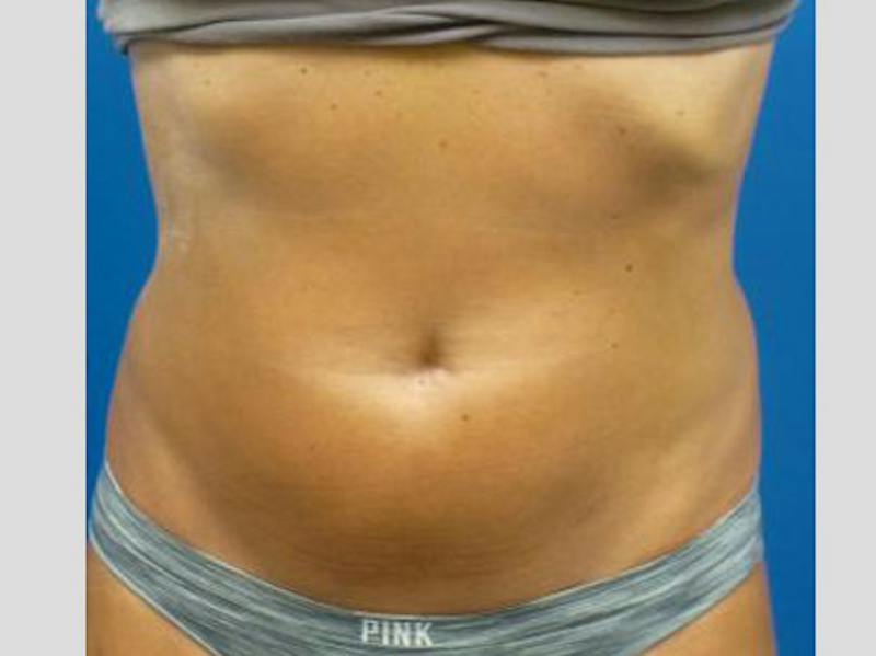 Sculpsure Before & After Gallery - Patient 387486 - Image 2