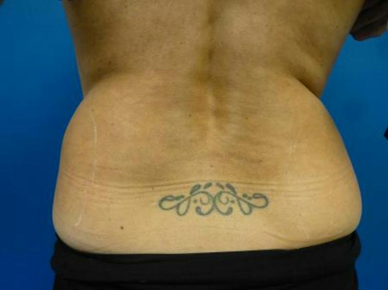 Sculpsure Before & After Gallery - Patient 387486 - Image 3