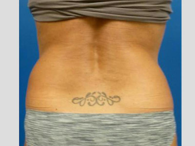 Sculpsure Before & After Gallery - Patient 387486 - Image 4