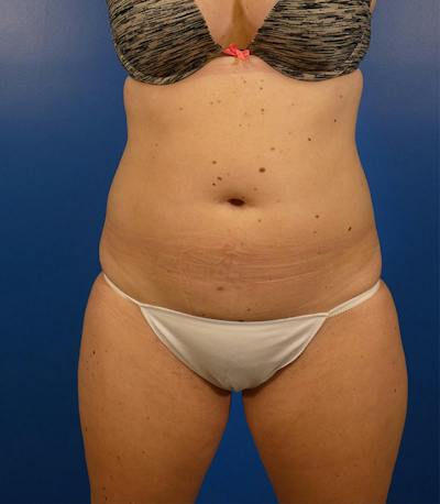 Sculpsure Before & After Gallery - Patient 962544 - Image 1