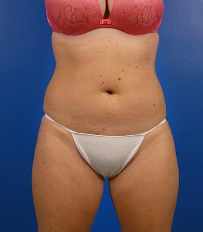 Sculpsure Before & After Gallery - Patient 962544 - Image 2