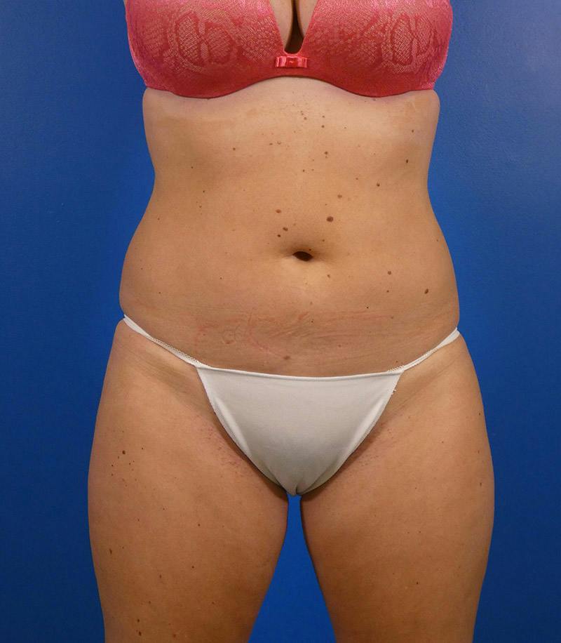 Sculpsure Before & After Gallery - Patient 962544 - Image 2