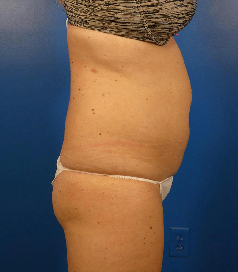 Sculpsure Before & After Gallery - Patient 962544 - Image 3