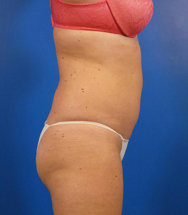 Sculpsure Before & After Gallery - Patient 962544 - Image 4