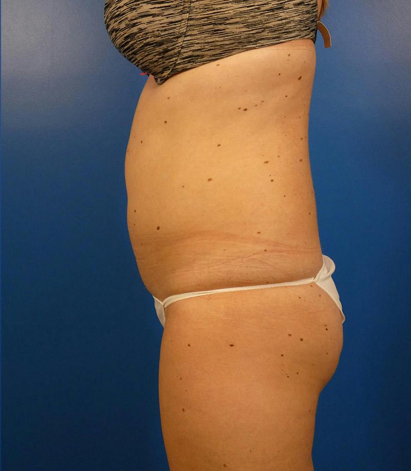 Sculpsure Before & After Gallery - Patient 962544 - Image 5