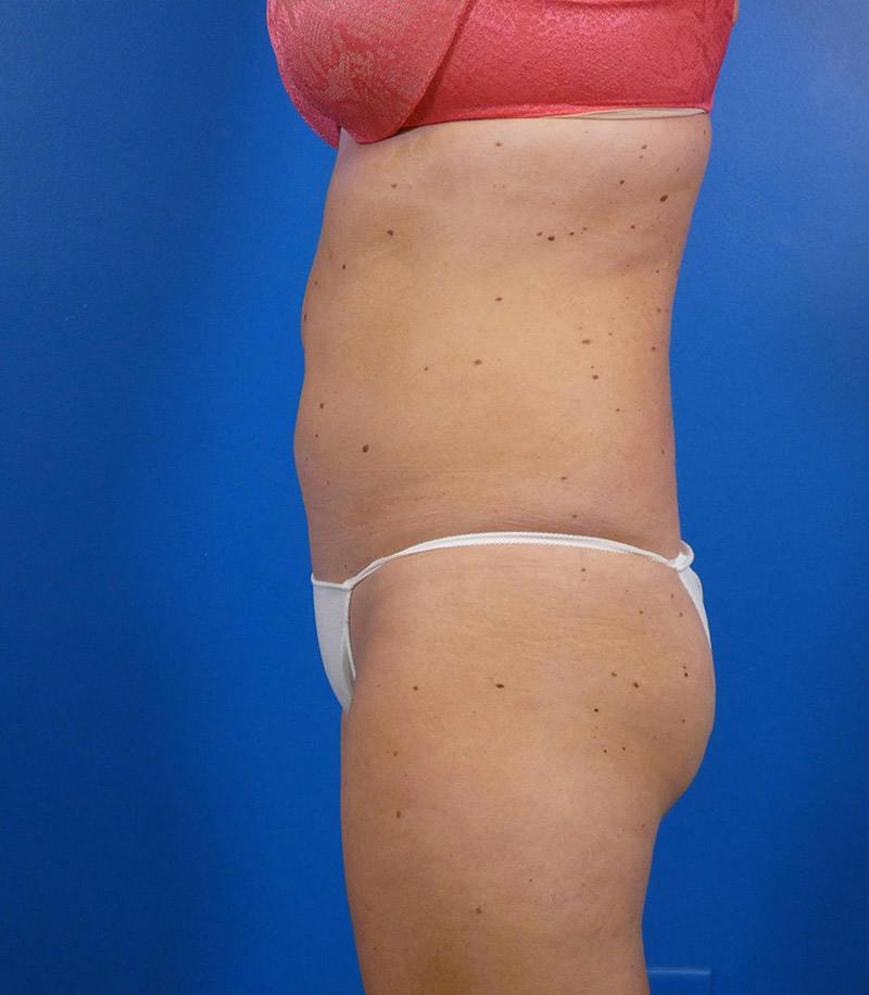 Sculpsure Before & After Gallery - Patient 962544 - Image 6