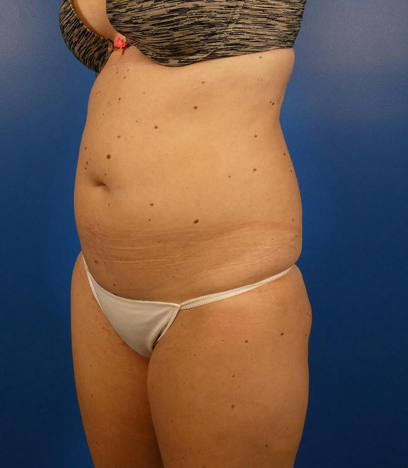Sculpsure Before & After Gallery - Patient 962544 - Image 7