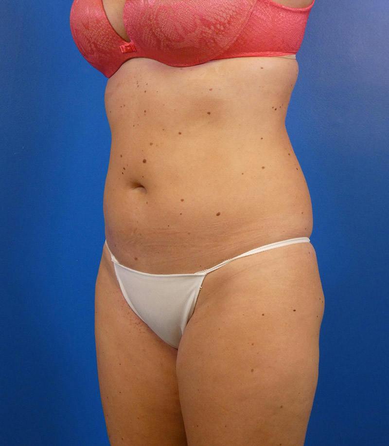 Sculpsure Before & After Gallery - Patient 962544 - Image 8