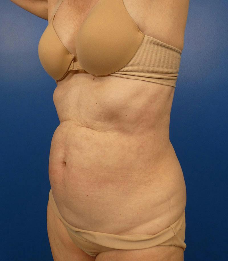Sculpsure Before & After Gallery - Patient 130581 - Image 1