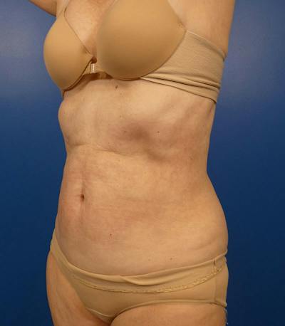 Sculpsure Before & After Gallery - Patient 130581 - Image 2