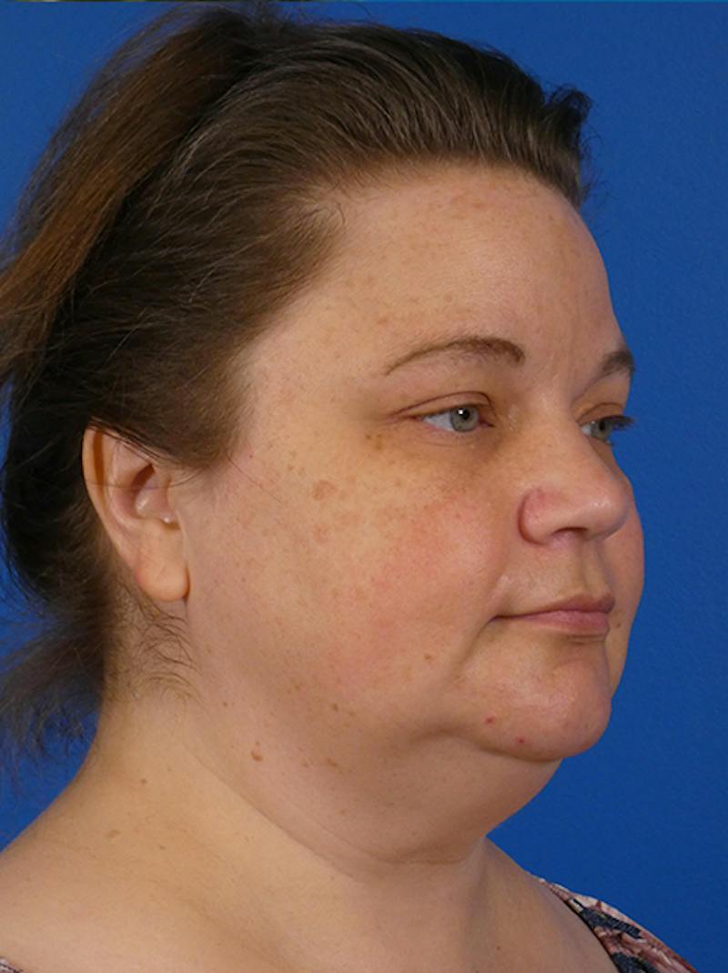 Thermitight Before & After Gallery - Patient 323753 - Image 1