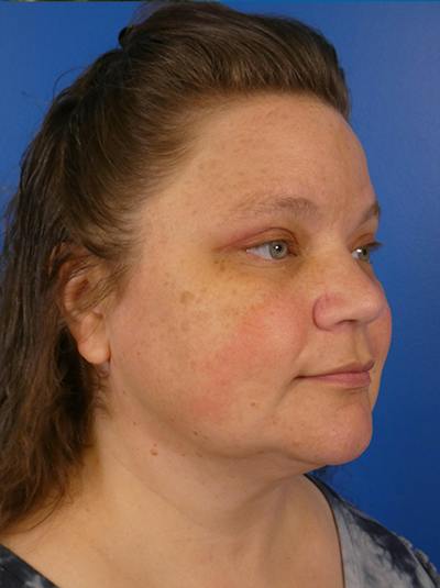 Thermitight Before & After Gallery - Patient 323753 - Image 2