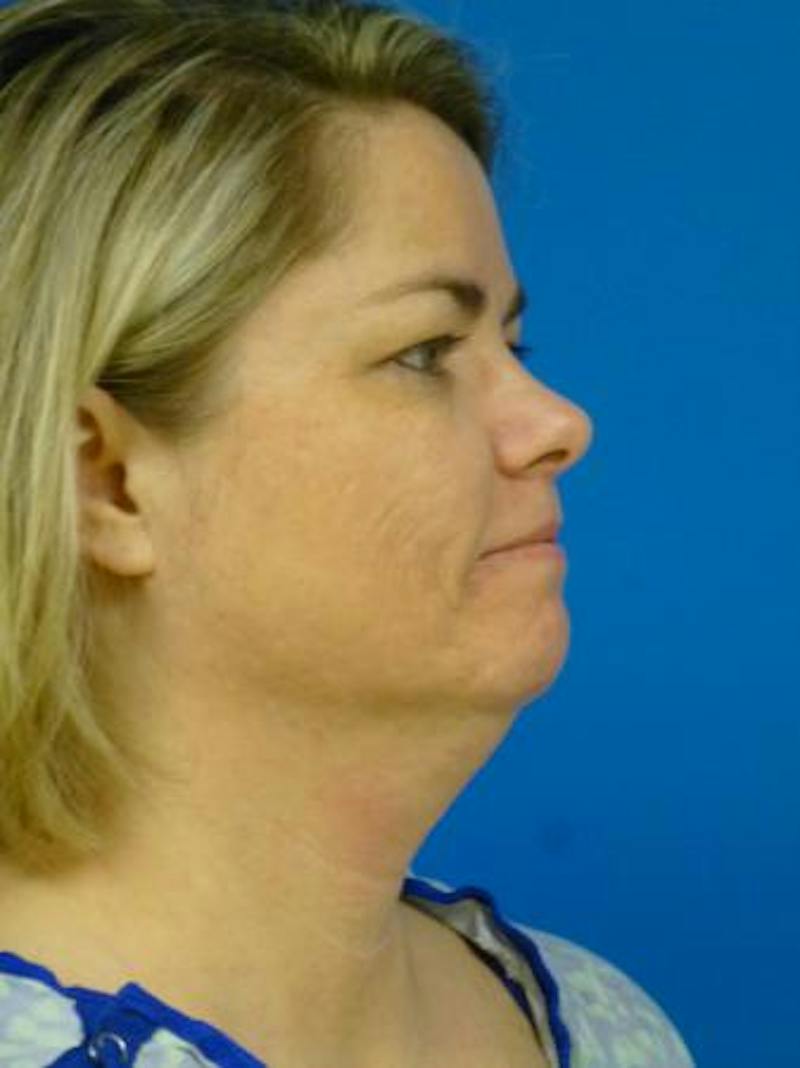 Thermitight Before & After Gallery - Patient 379593 - Image 1