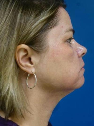 Thermitight Before & After Gallery - Patient 379593 - Image 2