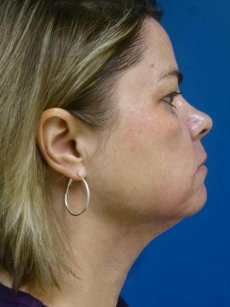 Thermitight Before & After Gallery - Patient 379593 - Image 2