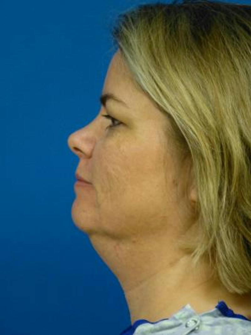 Thermitight Before & After Gallery - Patient 379593 - Image 3