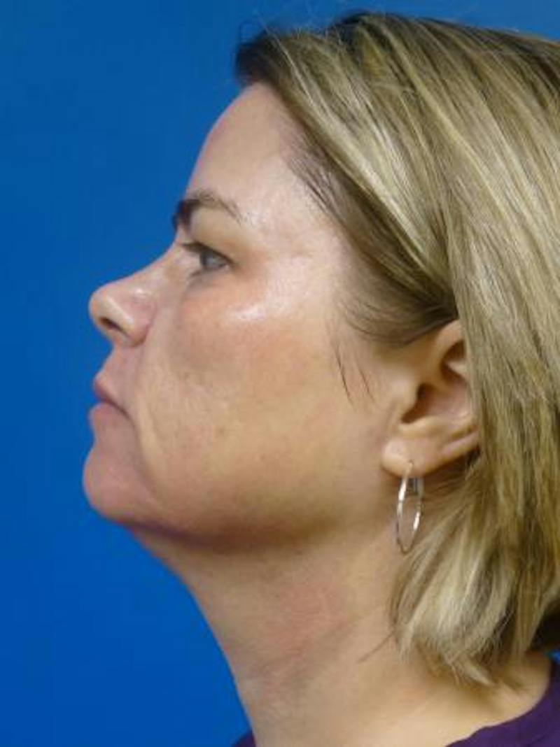 Thermitight Before & After Gallery - Patient 379593 - Image 4