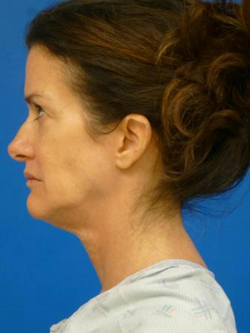 Thermitight Before & After Gallery - Patient 276865 - Image 1