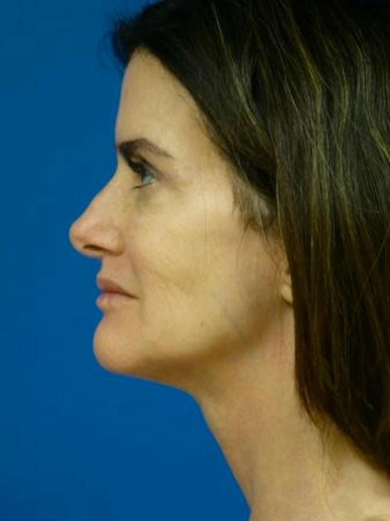 Thermitight Before & After Gallery - Patient 276865 - Image 2
