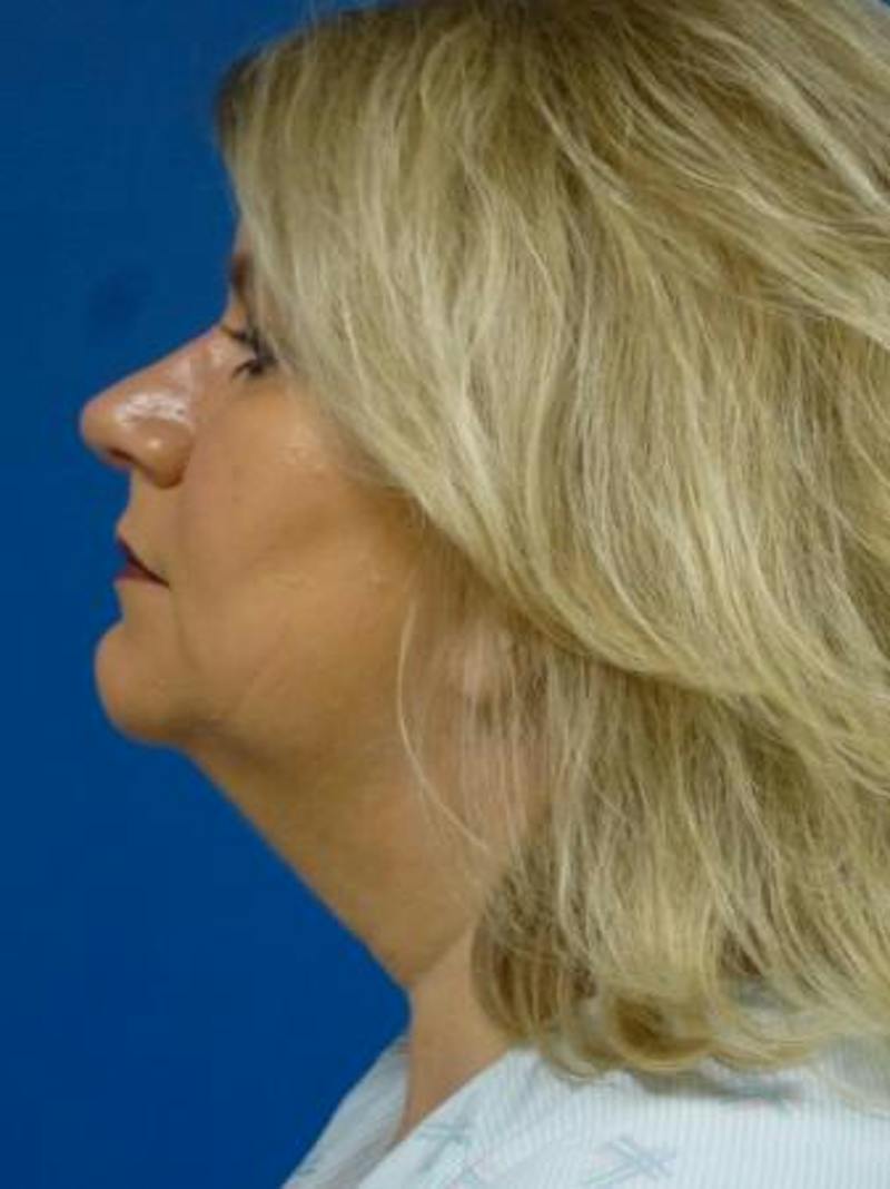 Thermitight Before & After Gallery - Patient 275611 - Image 1
