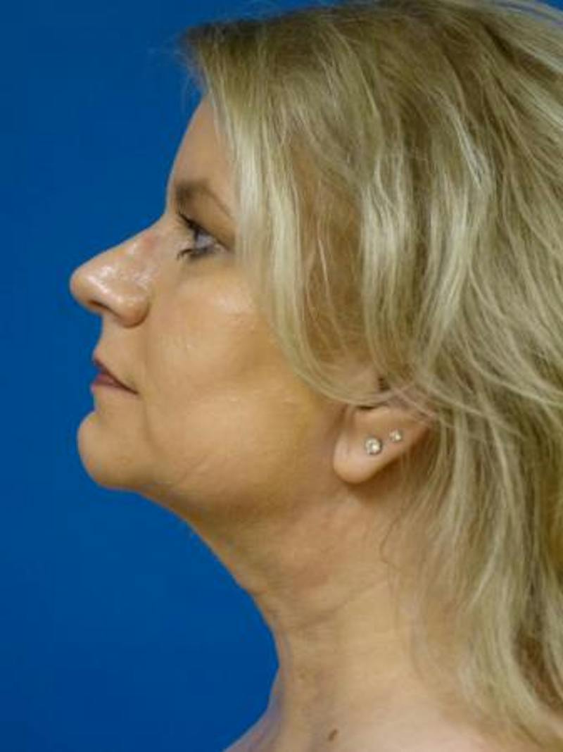 Thermitight Before & After Gallery - Patient 275611 - Image 2