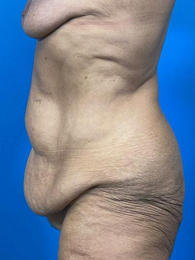 Tummy Tuck Before & After Gallery - Patient 203186 - Image 1