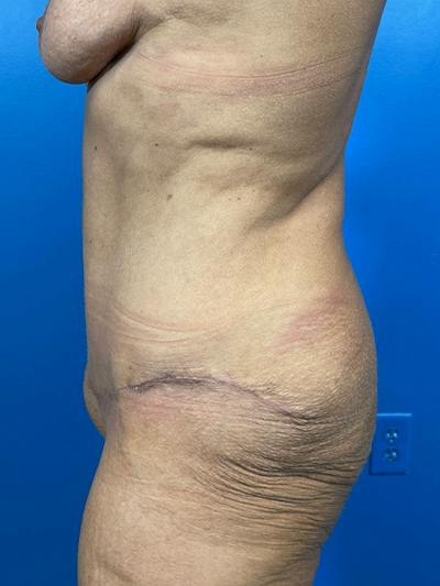 Tummy Tuck Before & After Gallery - Patient 203186 - Image 2
