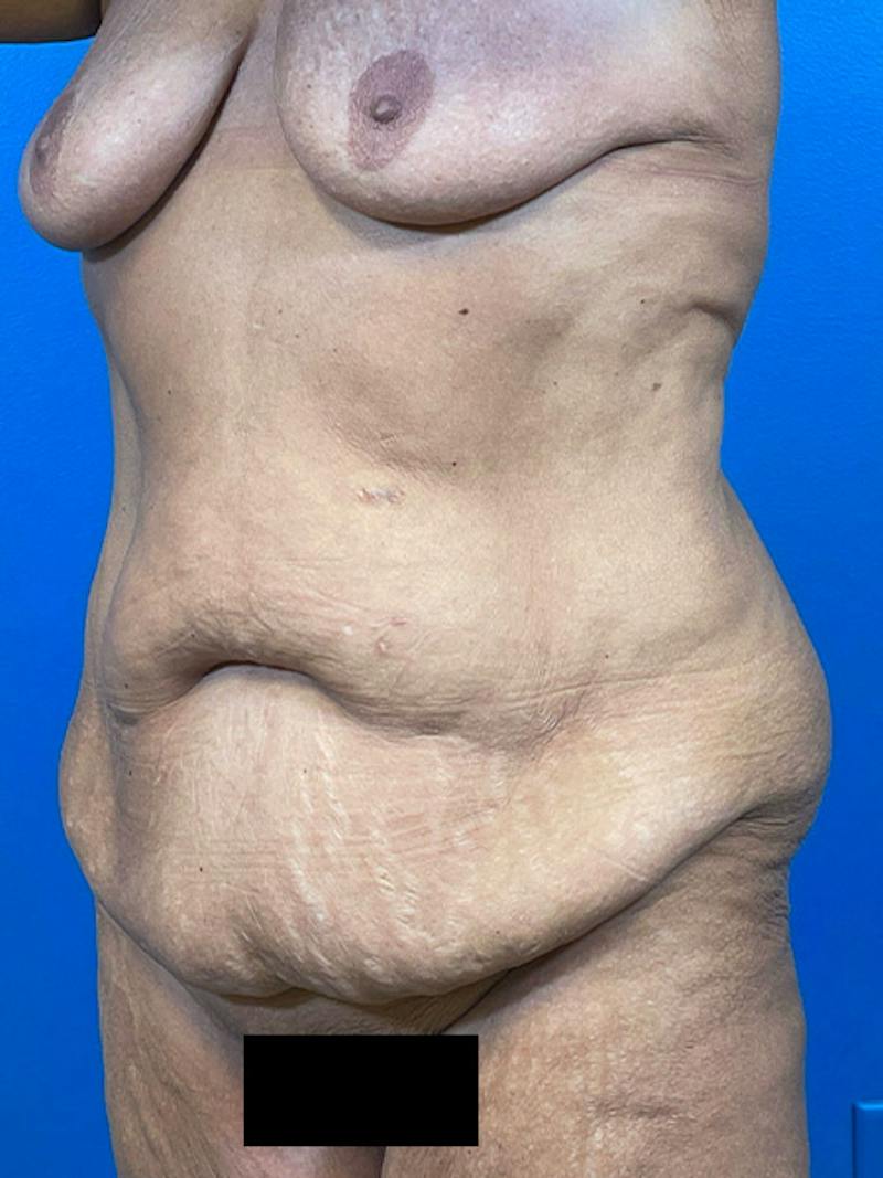 Tummy Tuck Before & After Gallery - Patient 203186 - Image 3