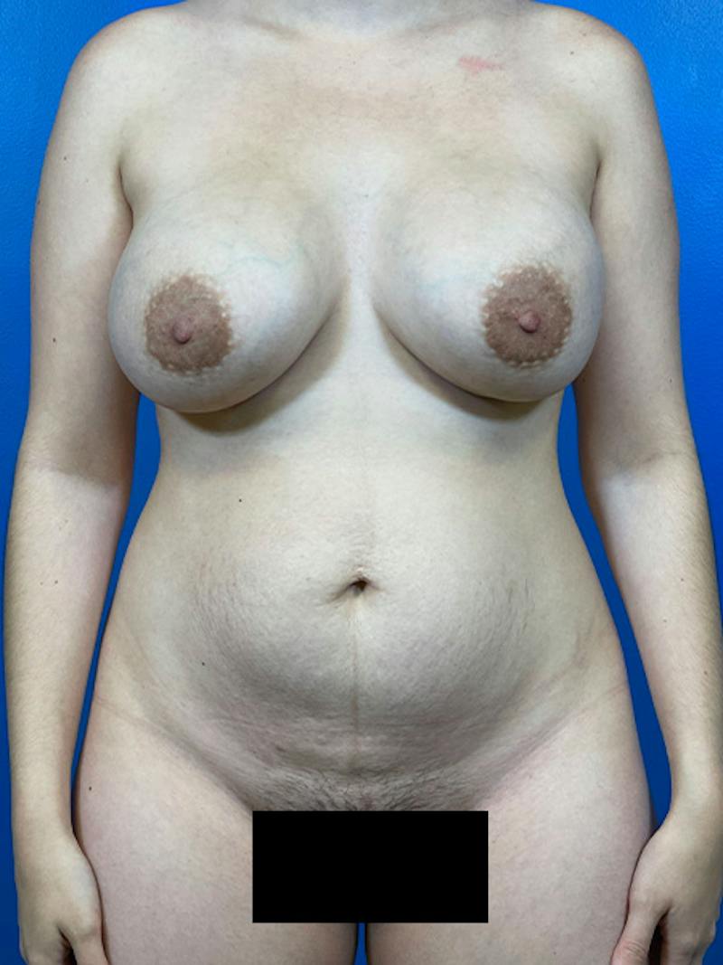 Tummy Tuck Before & After Gallery - Patient 303039 - Image 1