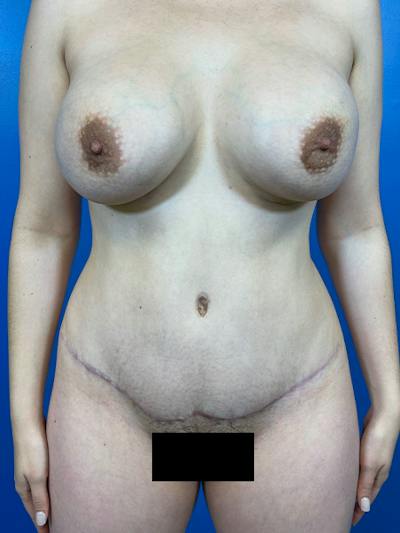 Tummy Tuck Before & After Gallery - Patient 303039 - Image 2