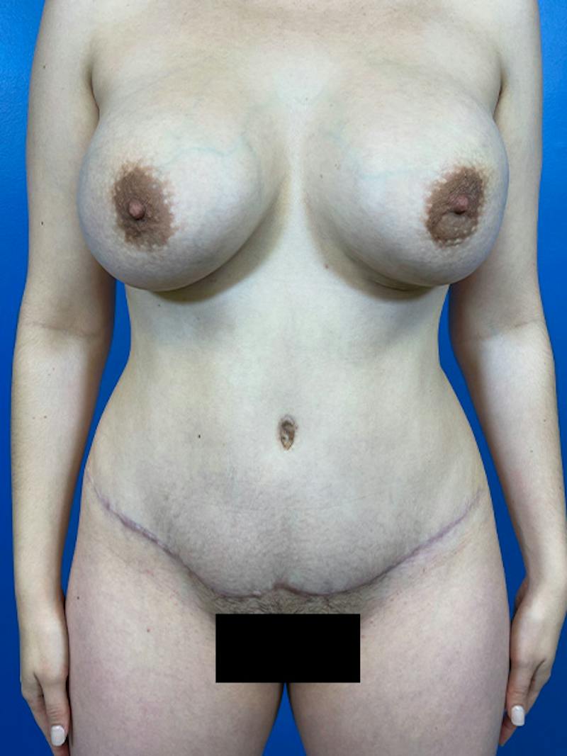 Tummy Tuck Before & After Gallery - Patient 303039 - Image 2