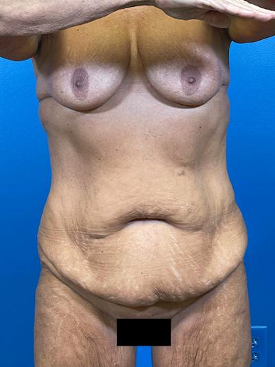 Tummy Tuck Before & After Gallery - Patient 394643 - Image 1