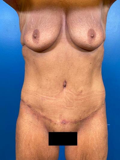 Tummy Tuck Before & After Gallery - Patient 394643 - Image 2