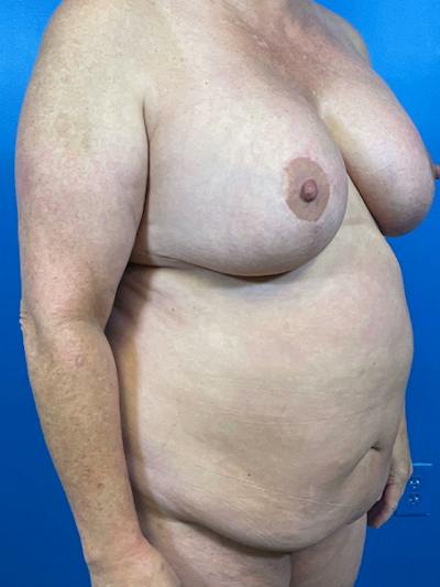 Tummy Tuck Before & After Gallery - Patient 204776 - Image 1
