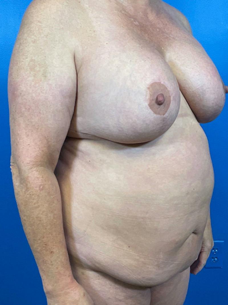 Tummy Tuck Before & After Gallery - Patient 204776 - Image 1