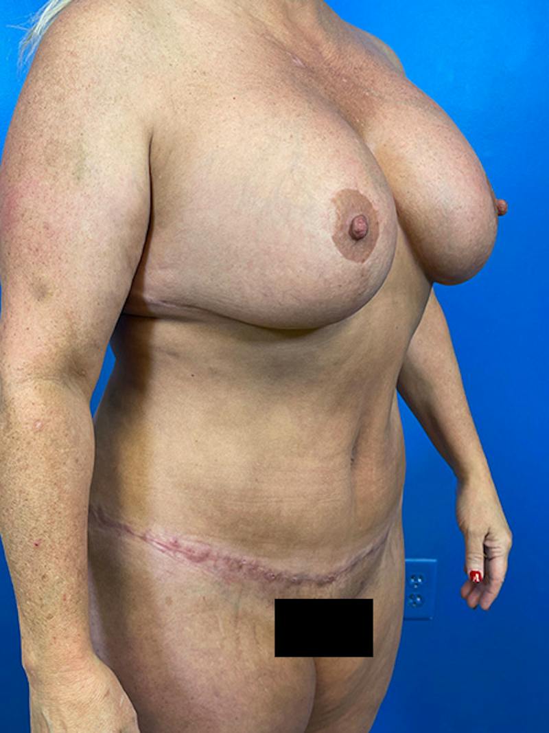 Tummy Tuck Before & After Gallery - Patient 204776 - Image 2
