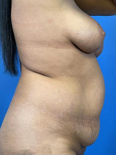 Tummy Tuck Before & After Gallery - Patient 414596 - Image 1