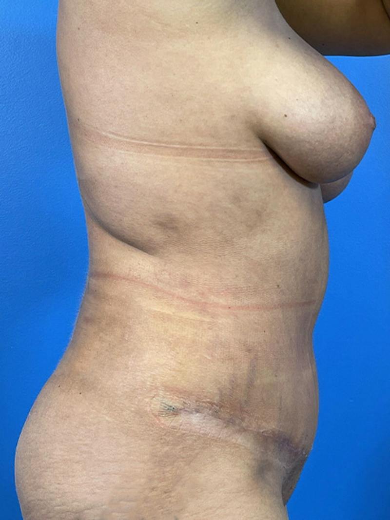 Tummy Tuck Before & After Gallery - Patient 414596 - Image 2