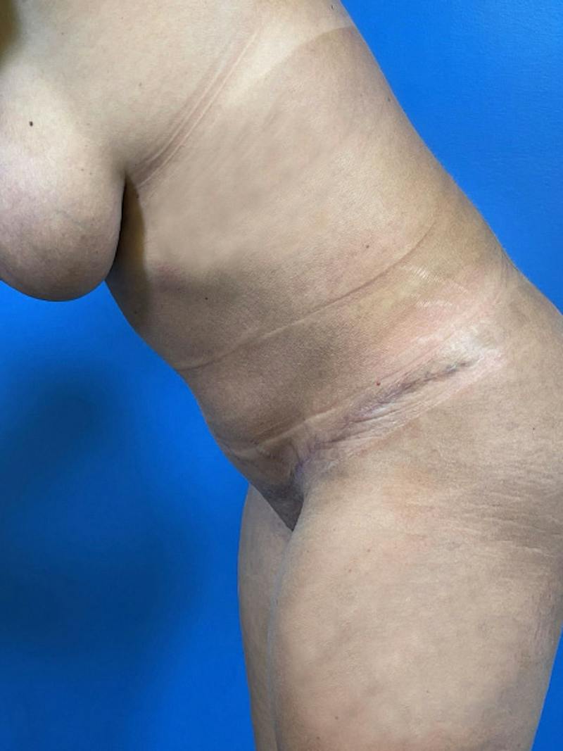 Tummy Tuck Before & After Gallery - Patient 414596 - Image 4