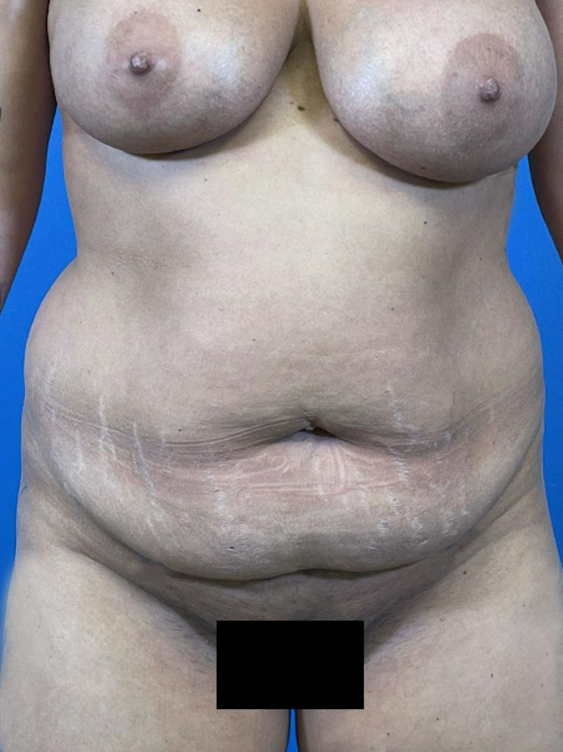 Tummy Tuck Before & After Gallery - Patient 414596 - Image 5