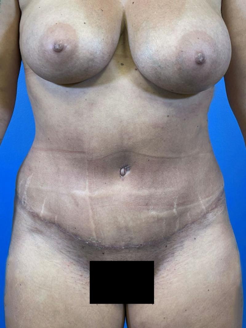 Tummy Tuck Before & After Gallery - Patient 414596 - Image 6