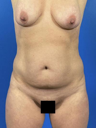 Tummy Tuck Before & After Gallery - Patient 299321 - Image 1