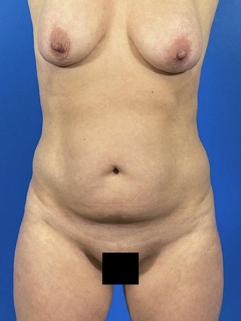 Tummy Tuck Before & After Gallery - Patient 299321 - Image 1