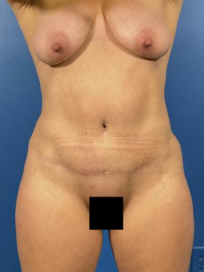 Tummy Tuck Before & After Gallery - Patient 299321 - Image 2