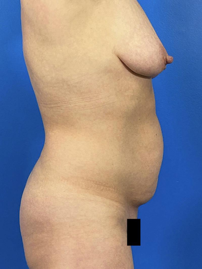 Tummy Tuck Before & After Gallery - Patient 299321 - Image 5