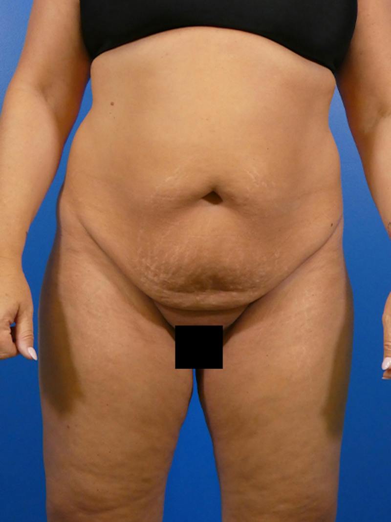 Tummy Tuck Before & After Gallery - Patient 275053 - Image 1